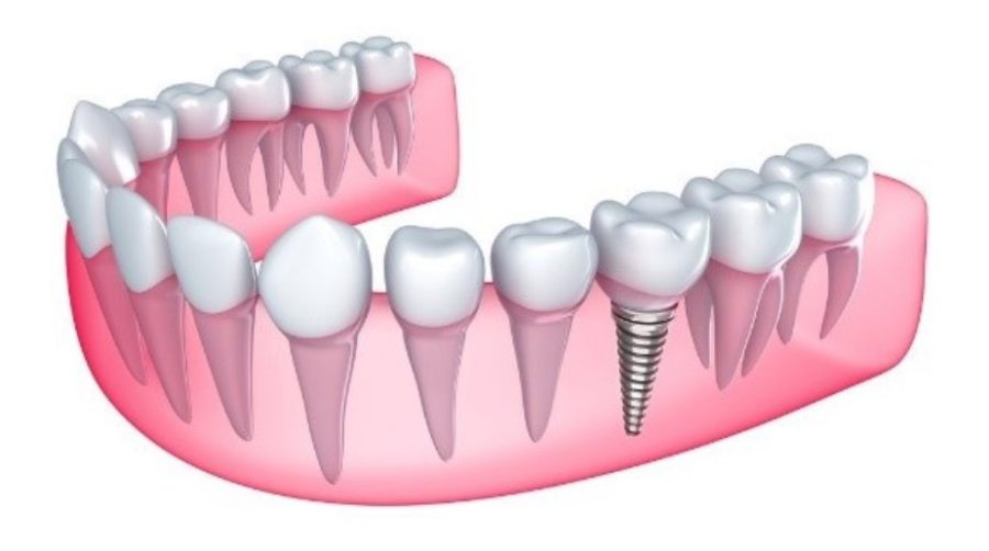 Mô phỏng vị trí trụ Implant Nobel tích hợp vững chắc trong khung hàm