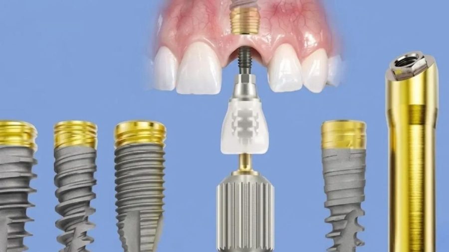 Cấu trúc đồng bộ giữa trụ Implant Nobel và Abutment trong phục hình răng